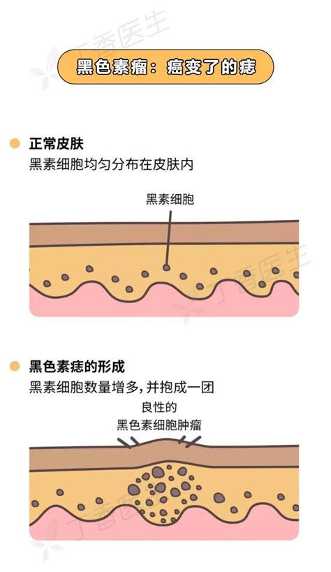 身上有痣|痣也可能会癌变！长在 3 个地方要注意